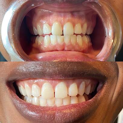 Brighter U Tooth De`Cor & Whitening